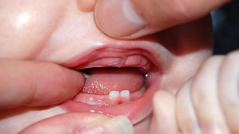 Thời điểm mọc răng cũng là lúc bé dễ quấy khóc, sốt, mất ngủ