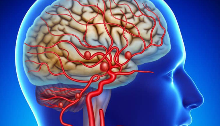 Phình động mạch não dễ dẫn tới đau đầu ở 2 bên thái dương